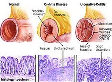 慢性潰瘍結腸炎的并發癥