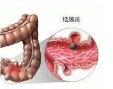 什么是結腸炎？結腸炎的癥狀有哪些？